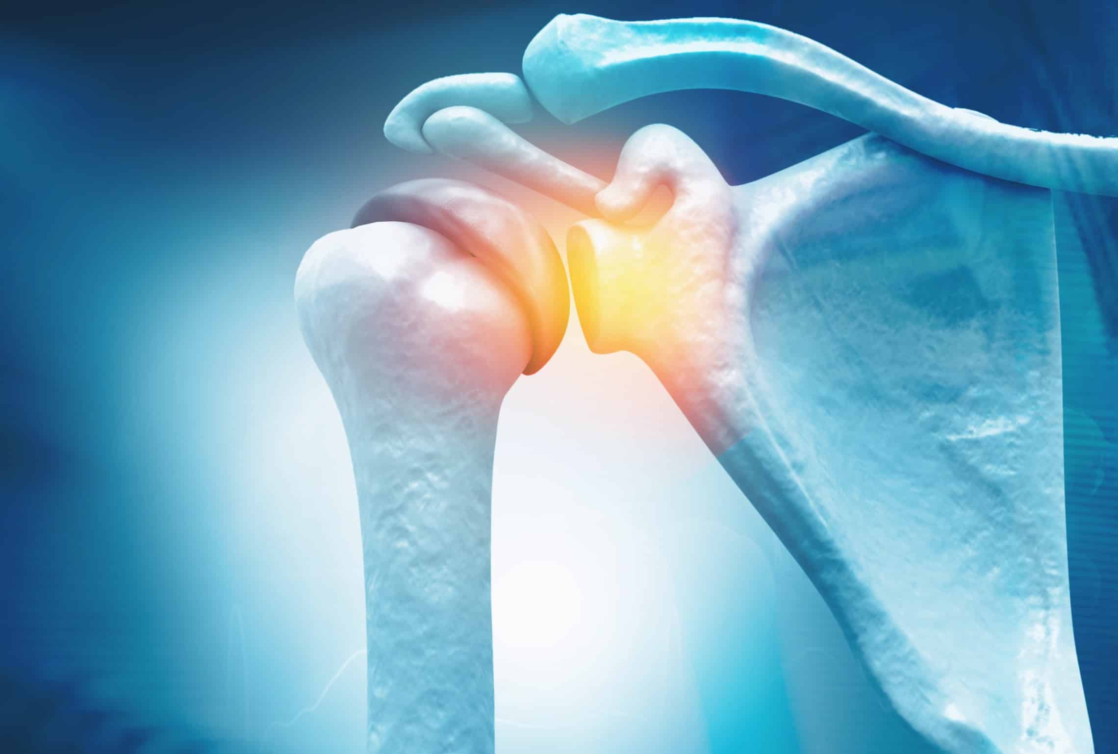 Arthrose épaule - Omarthrose : causes et traitements | Arthrose épaule symptômes | Dr Salabi | Marseille