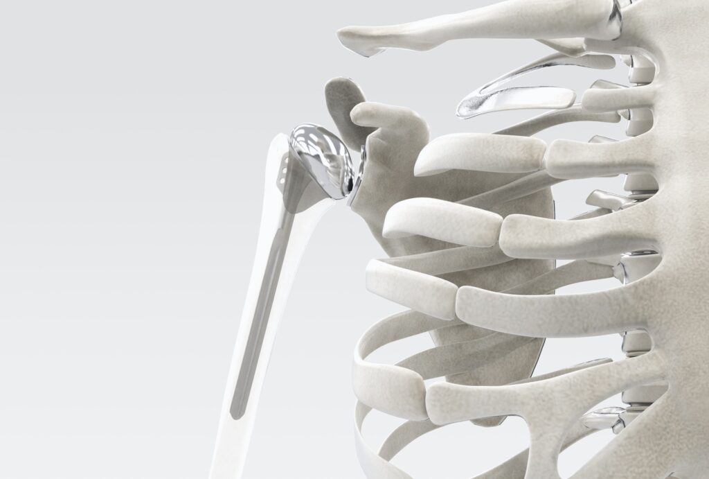 Prothèse totale d'épaule | ortho roncq