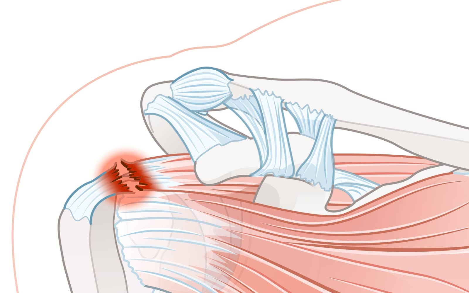 Qu’est-ce qu’une rupture dégénérative de la coiffe des rotateurs ? | Dr ...